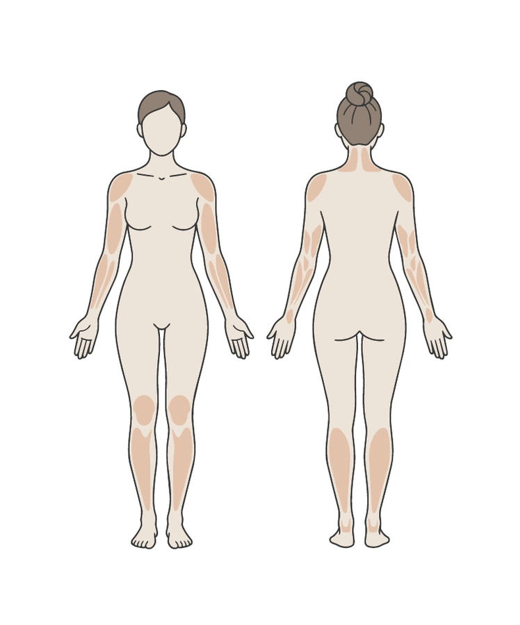 Ilustración de las zonas corporales recomendadas para la compresa de cuello APAPACHO